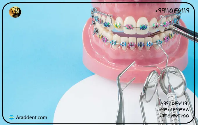 شرایط انجام ارتودنسی دندان