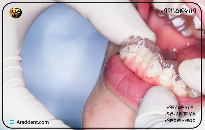 انواع روش های ارتودنسی دندان