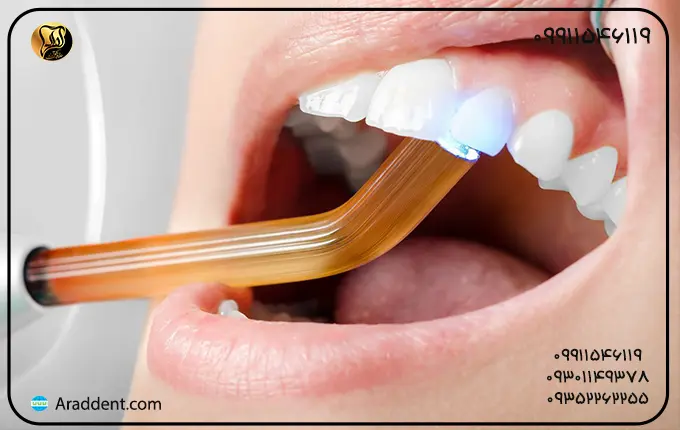 کامپوزیت دندان چیست چه مزایایی دارد؟