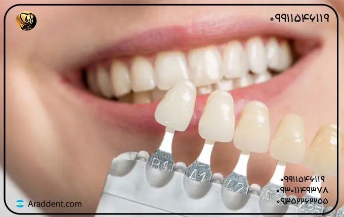 معایب کامپوزیت دندان